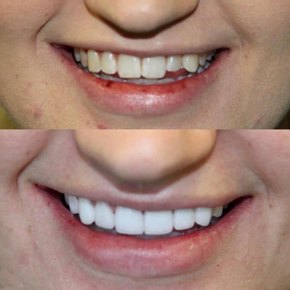 Cosmetic Veneers