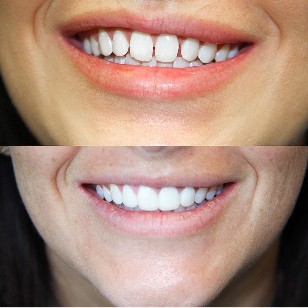 Cosmetic Veneers