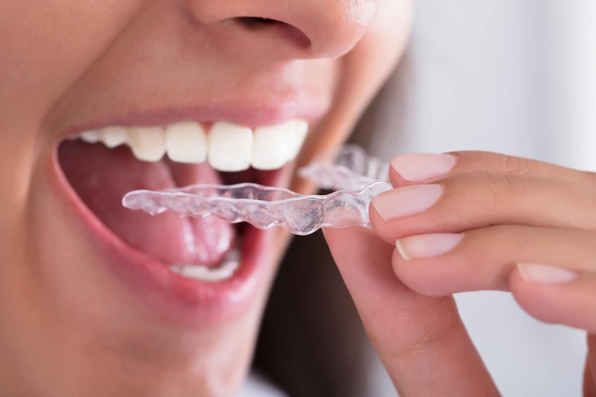 woman putting in Invisalign