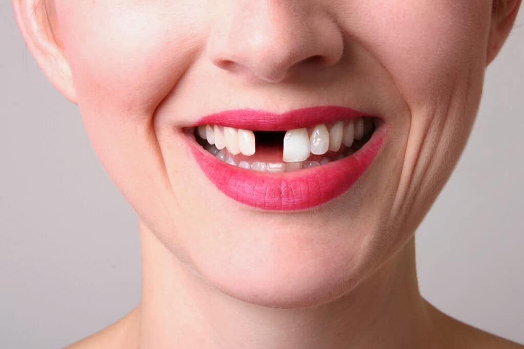 What Are the Best Long-Term Options for Replacing Missing Teeth?